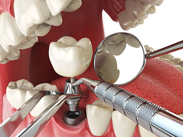 Best Emergency Broken Tooth Repair in USA